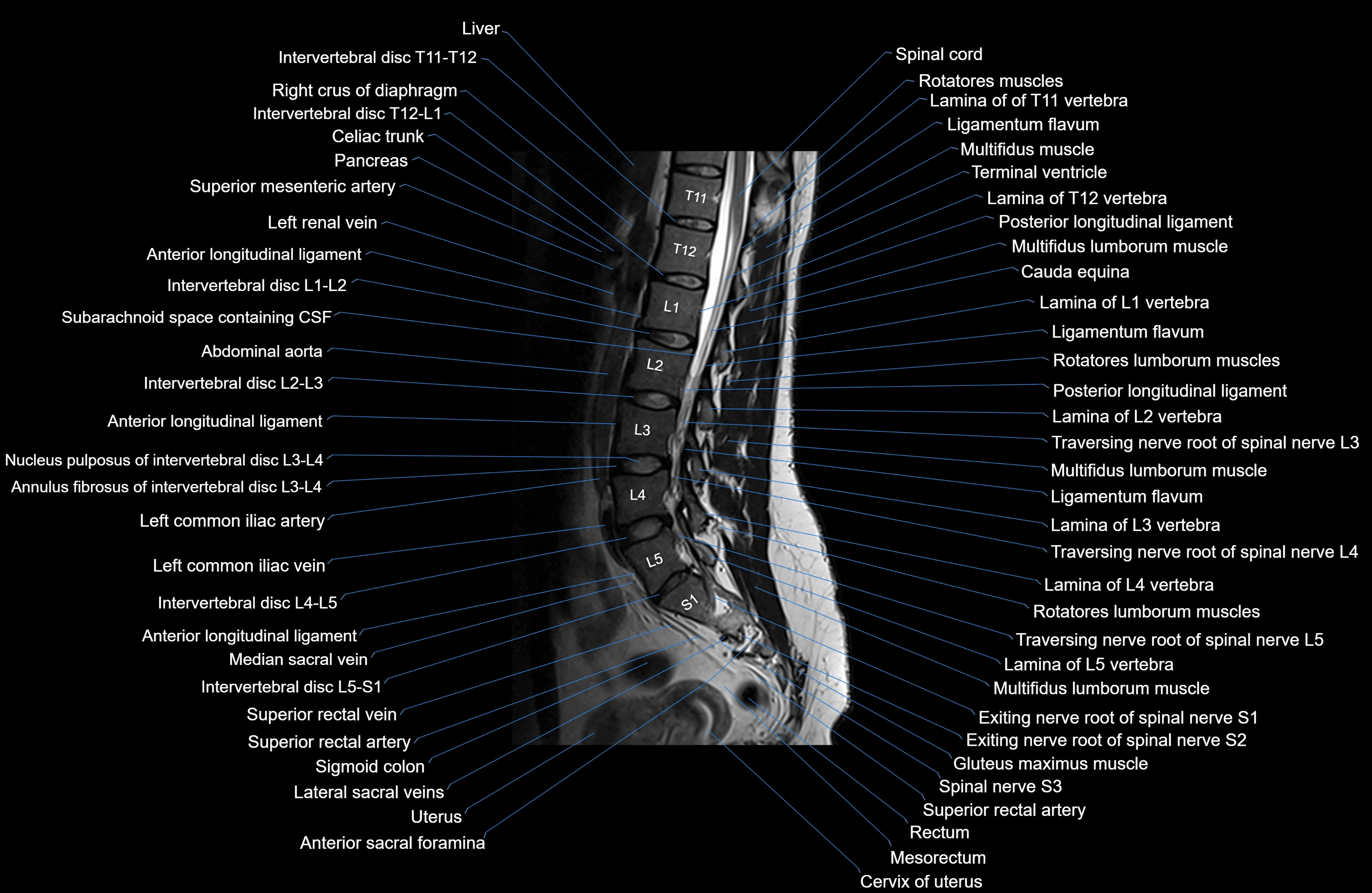 MRI lumbar spine sagittal cross sectional anatomy 3T radiology  image-img-00001-00017.webp